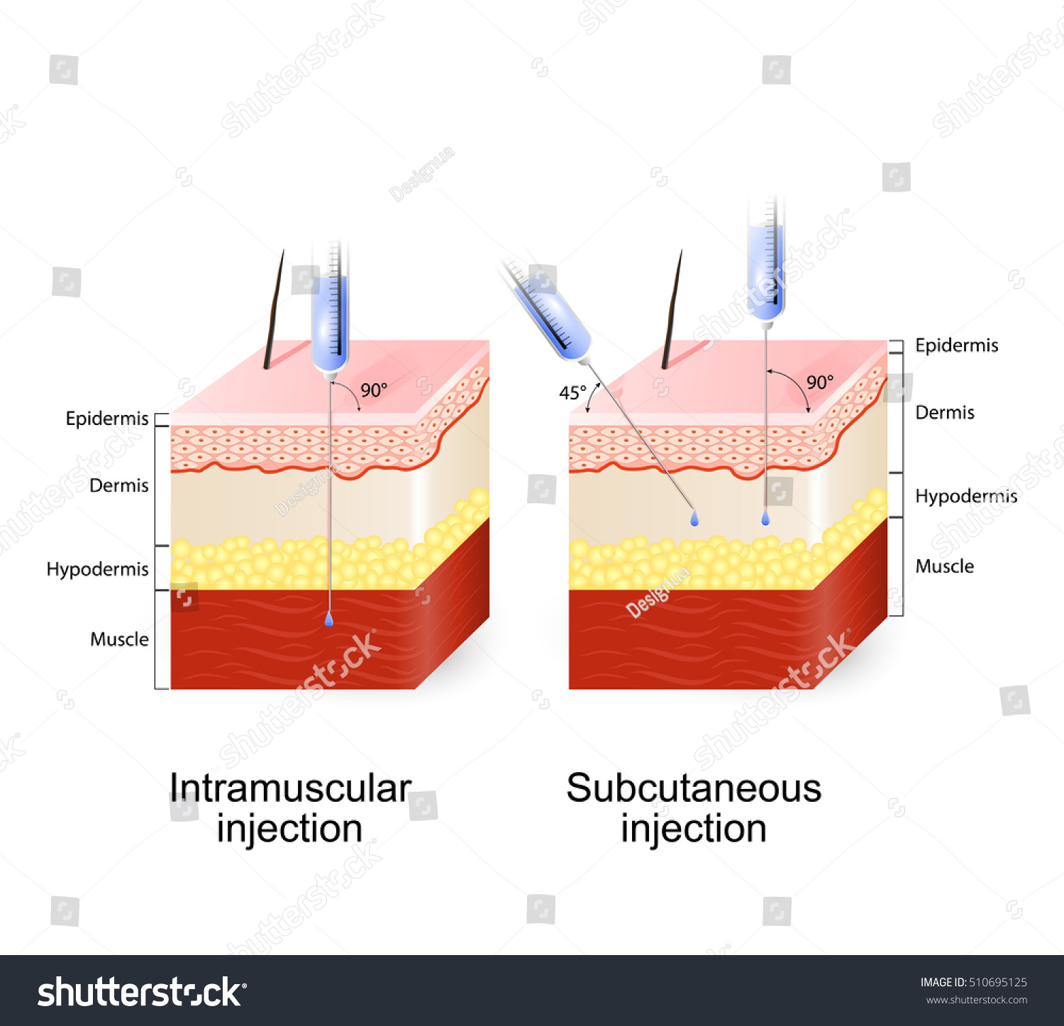 Intramuscular Injection Subcutaneous Injection Angle Depth 库存矢量图 免版税 510695125