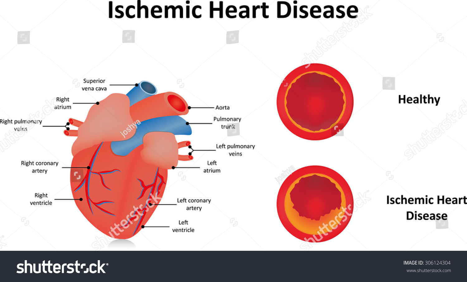 Ischemic Heart Disease Stock Vector Illustration 306124304 : Shutterstock