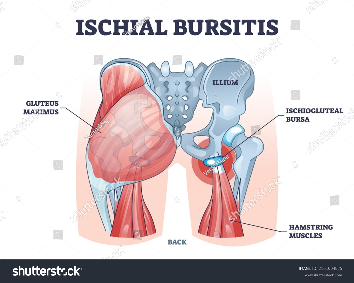 Ischial Bursitis Ischiogluteal Weavers Bottom Condition 库存矢量图（免版税）2161004825 Shutterstock 0029