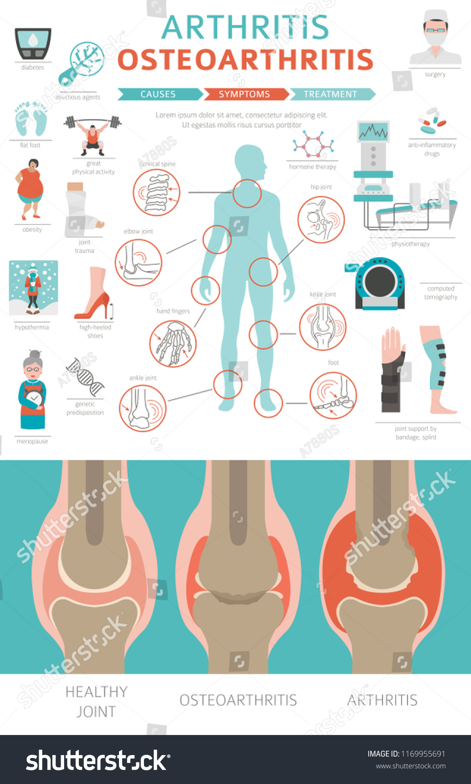 Joints Diseases Arthritis Osteoarthritis Symptoms Treatment Stock 