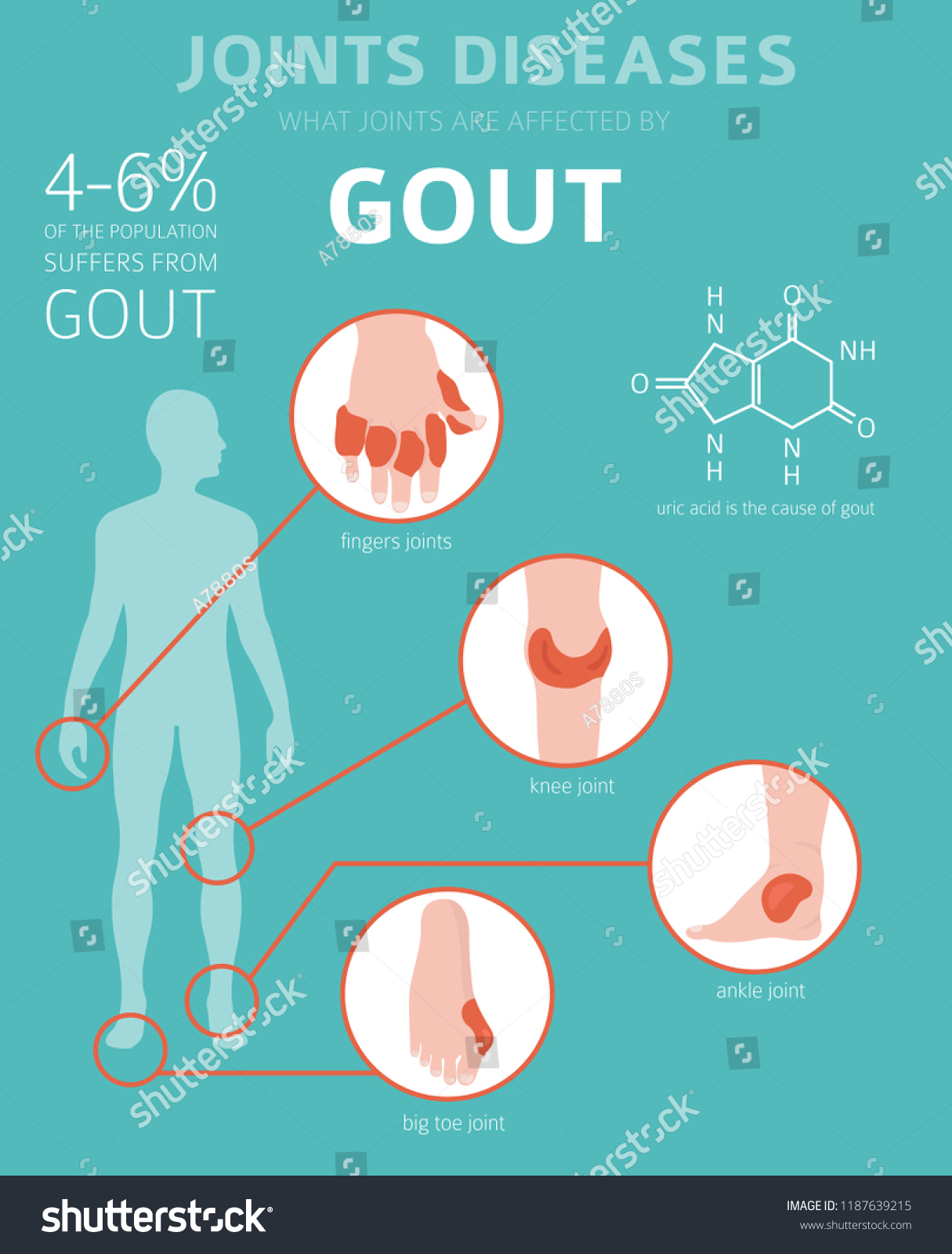 Symptoms gout 9 Pictures