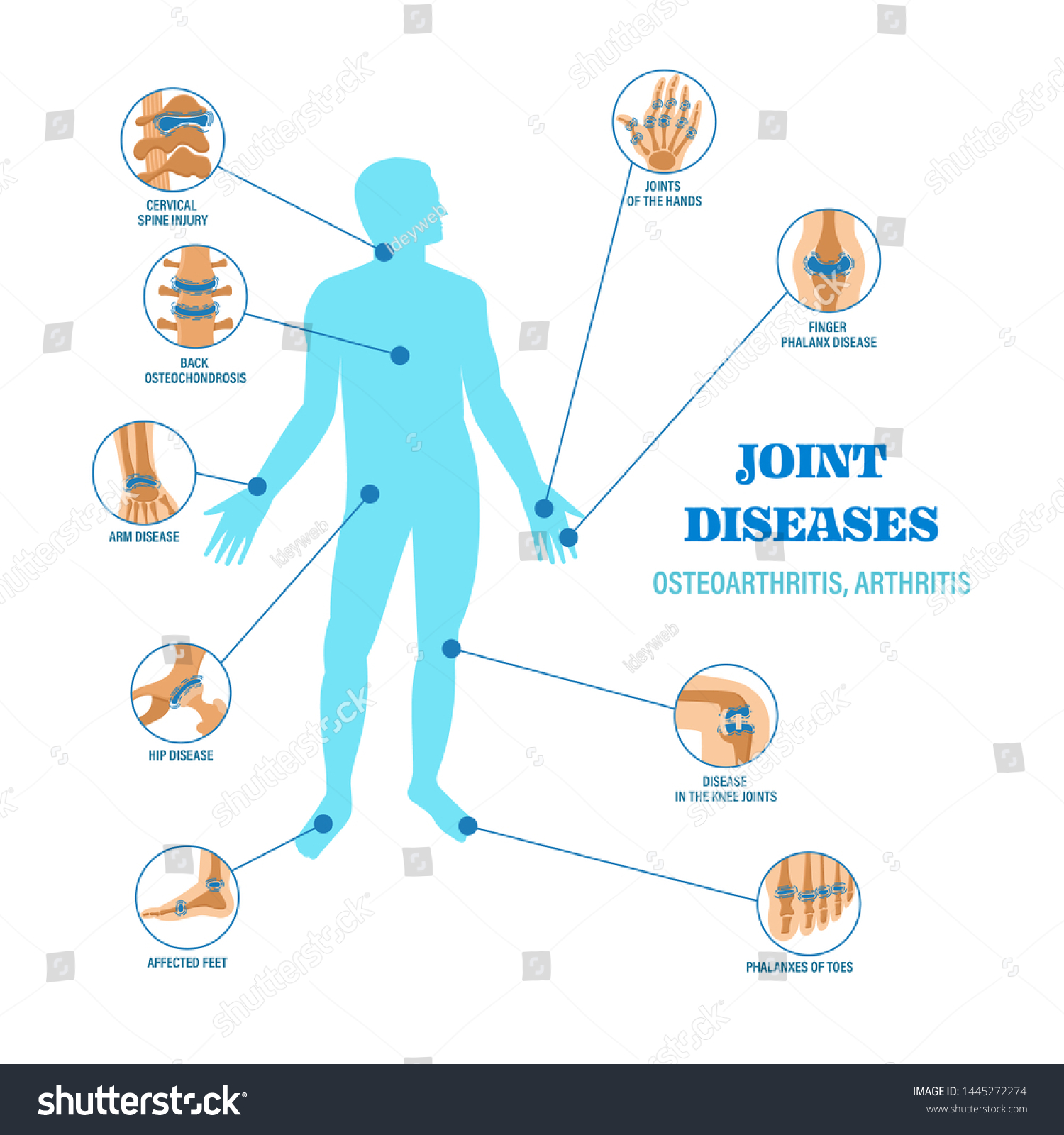 Joints Diseases Infographic Banner Arthritis Osteoarthritis: Vetor ...