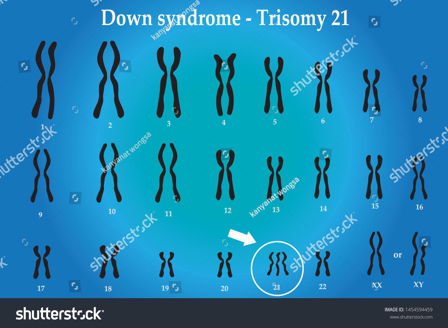 Karyotype Down Syndrome Ds Dns Known Vector De Stock Libre De Regalías 1454594459 Shutterstock 7363