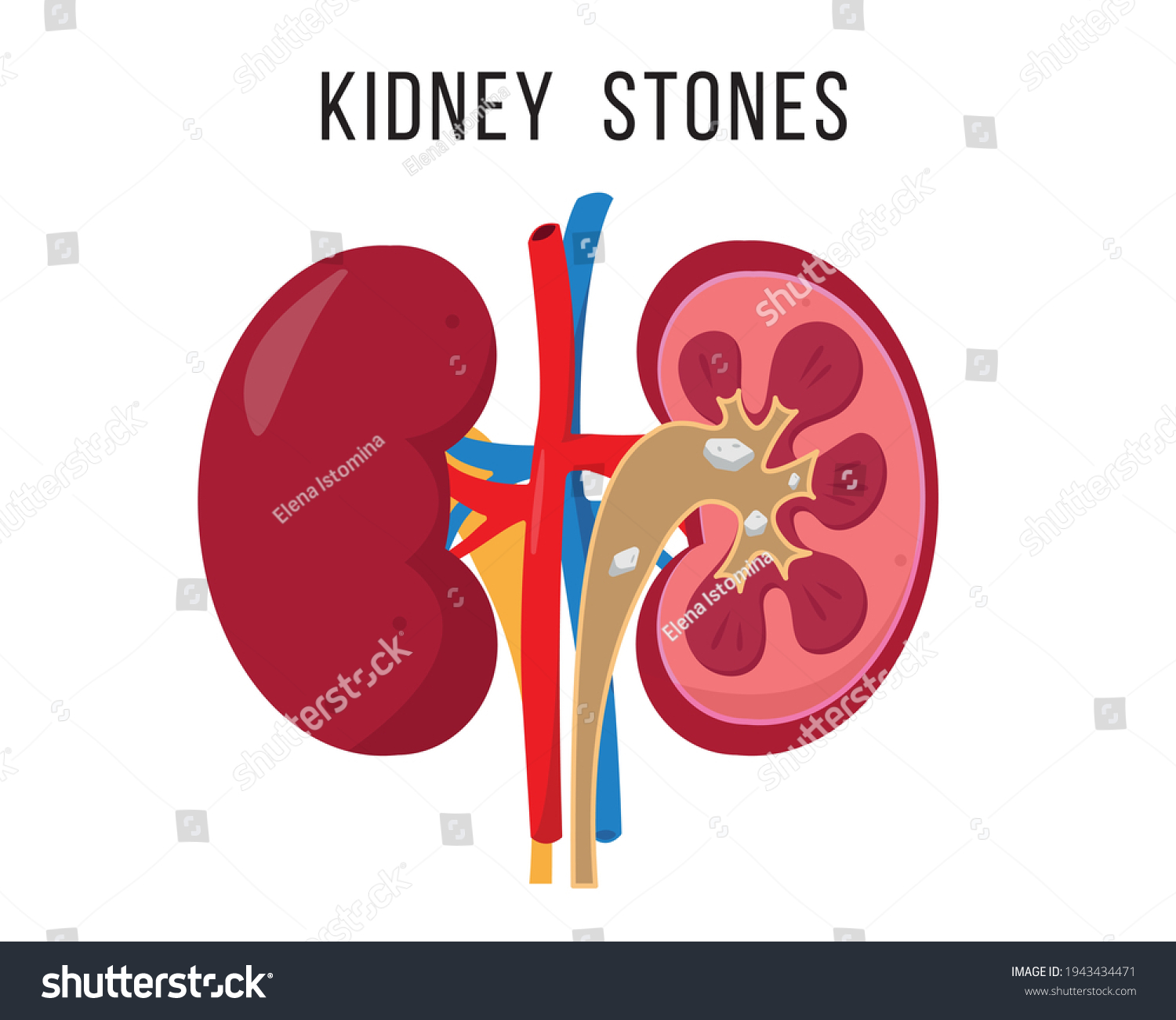 kidney-stone-disease-human-kidneys-anatomy-stock-vector-royalty-free