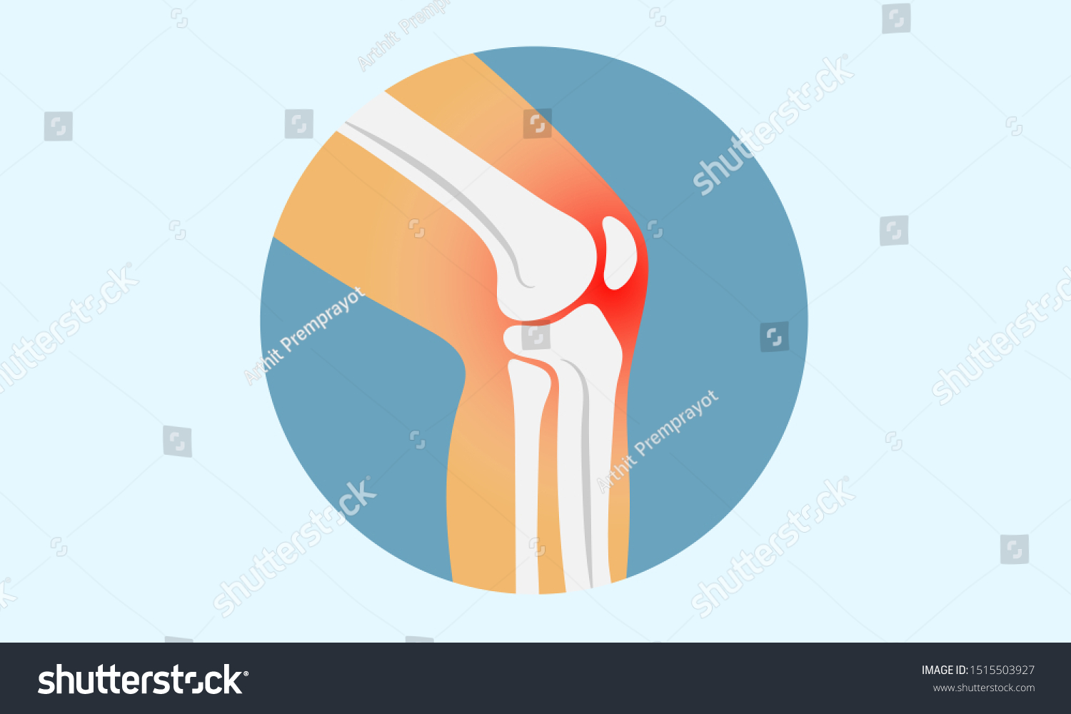 Knee Bone Osteoarthritis Vector Illustration Stock Vector (Royalty Free ...