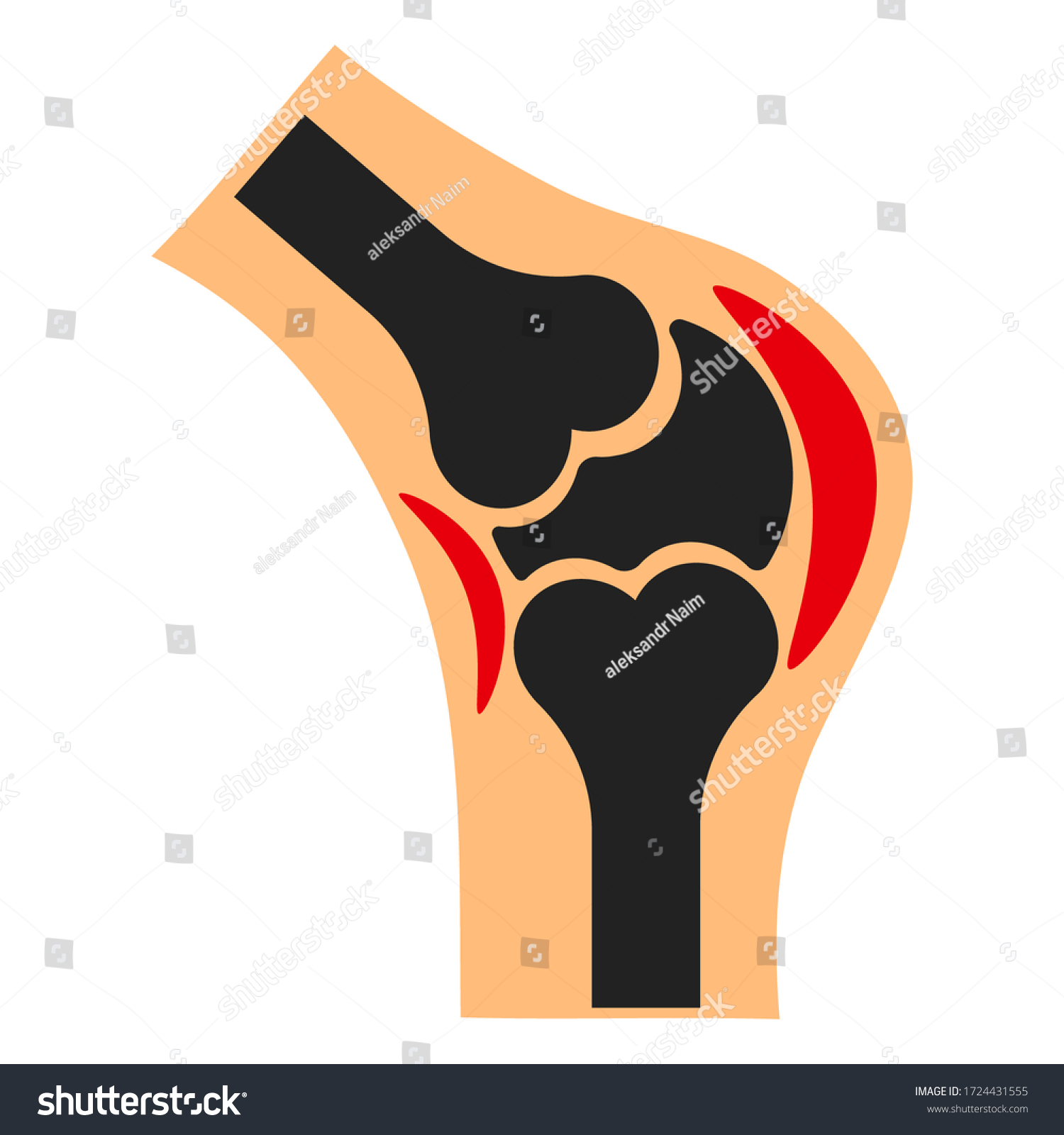 Knee Joint Inflammation On White Background Stock Vector (Royalty Free ...