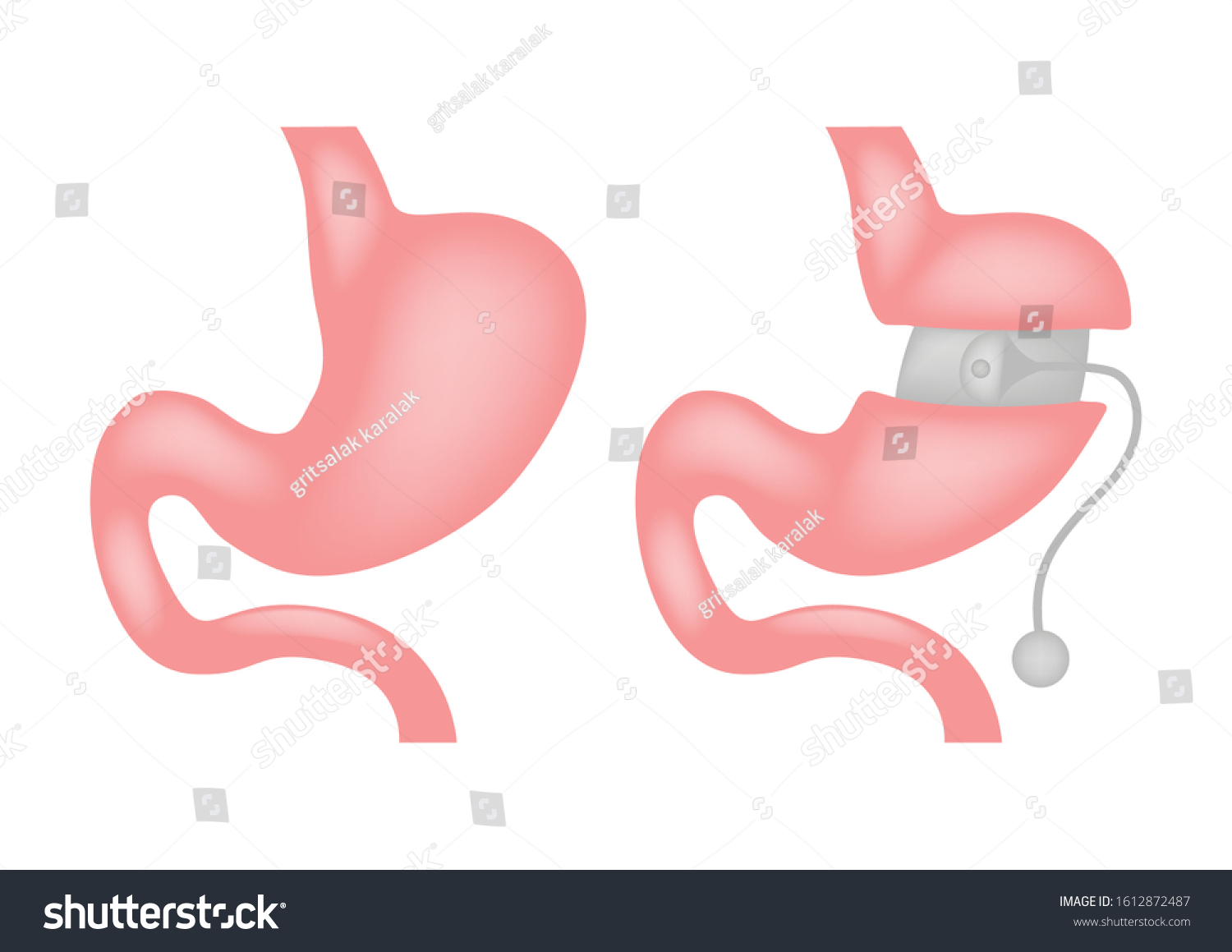 Laparoscopic Gastrectomy Gastric Sleeve Weight Loss Stock Vector