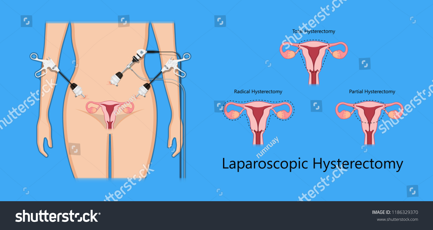 Laparoscopic Hysterectomy Medical Surgical Treat Cervix Stock Vector Royalty Free 1186329370 6204