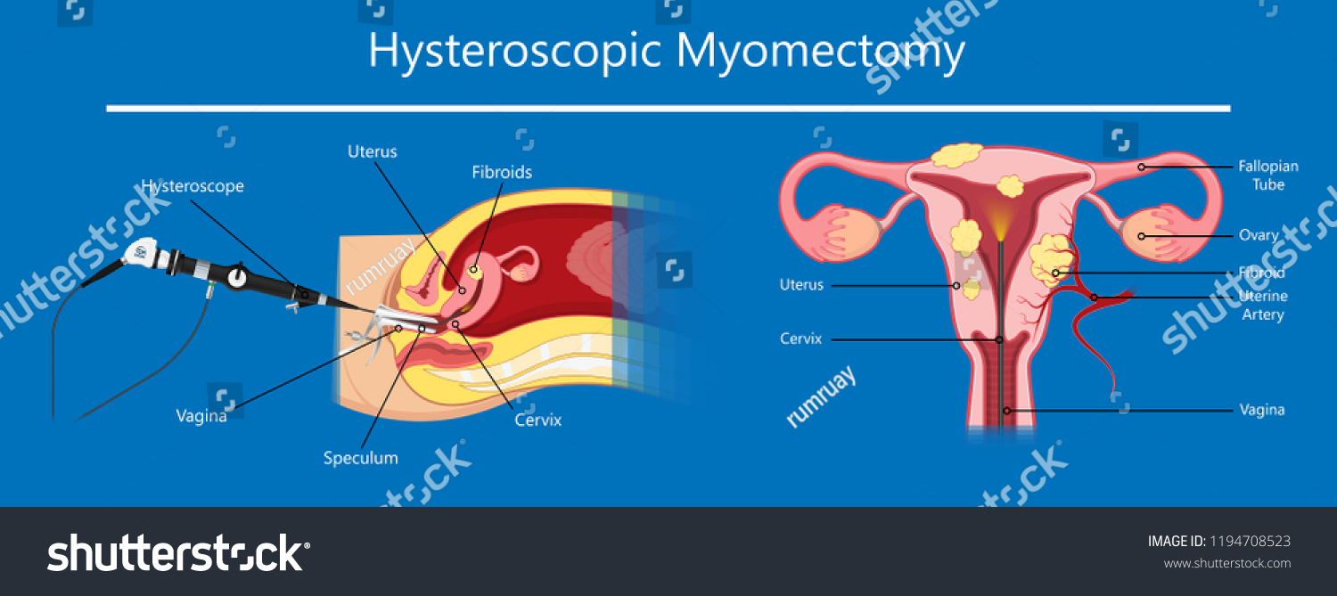 Laparoscopic Hysterectomy Medical Surgical Treat Cervix Stock Vector Royalty Free 1194708523 7635