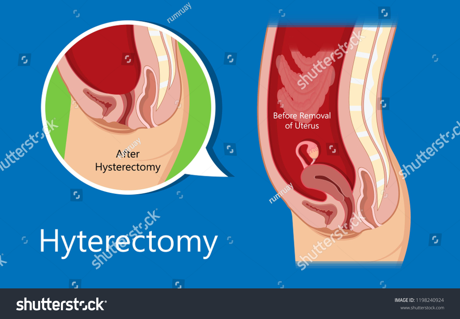 Laparoscopic Hysterectomy Medical Surgical Treat Cervix Stock Vector Royalty Free 1198240924