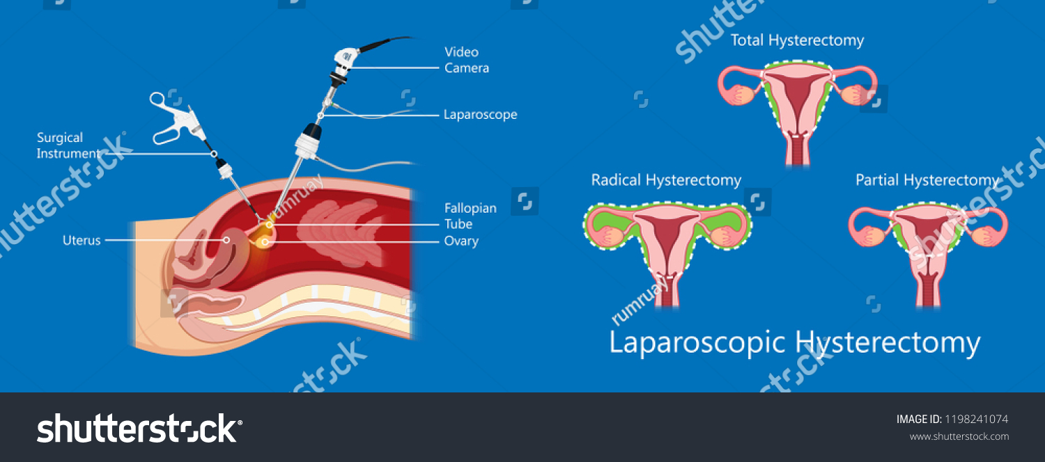 Laparoscopic Hysterectomy Medical Surgical Treat Cervix Stock Vector