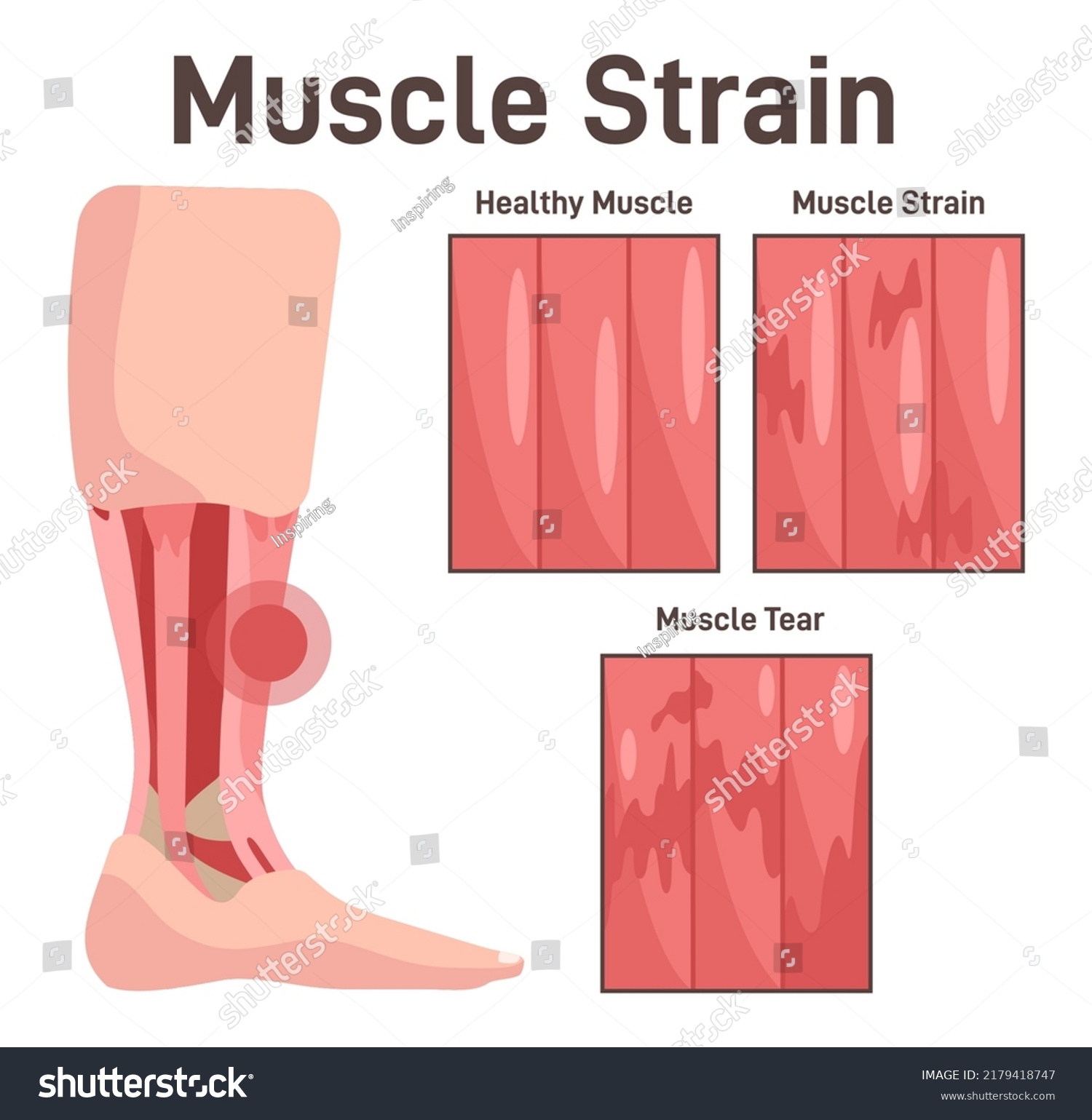 intercostal-muscle-strain-as-muscular-group-in-chest-cavity-outline