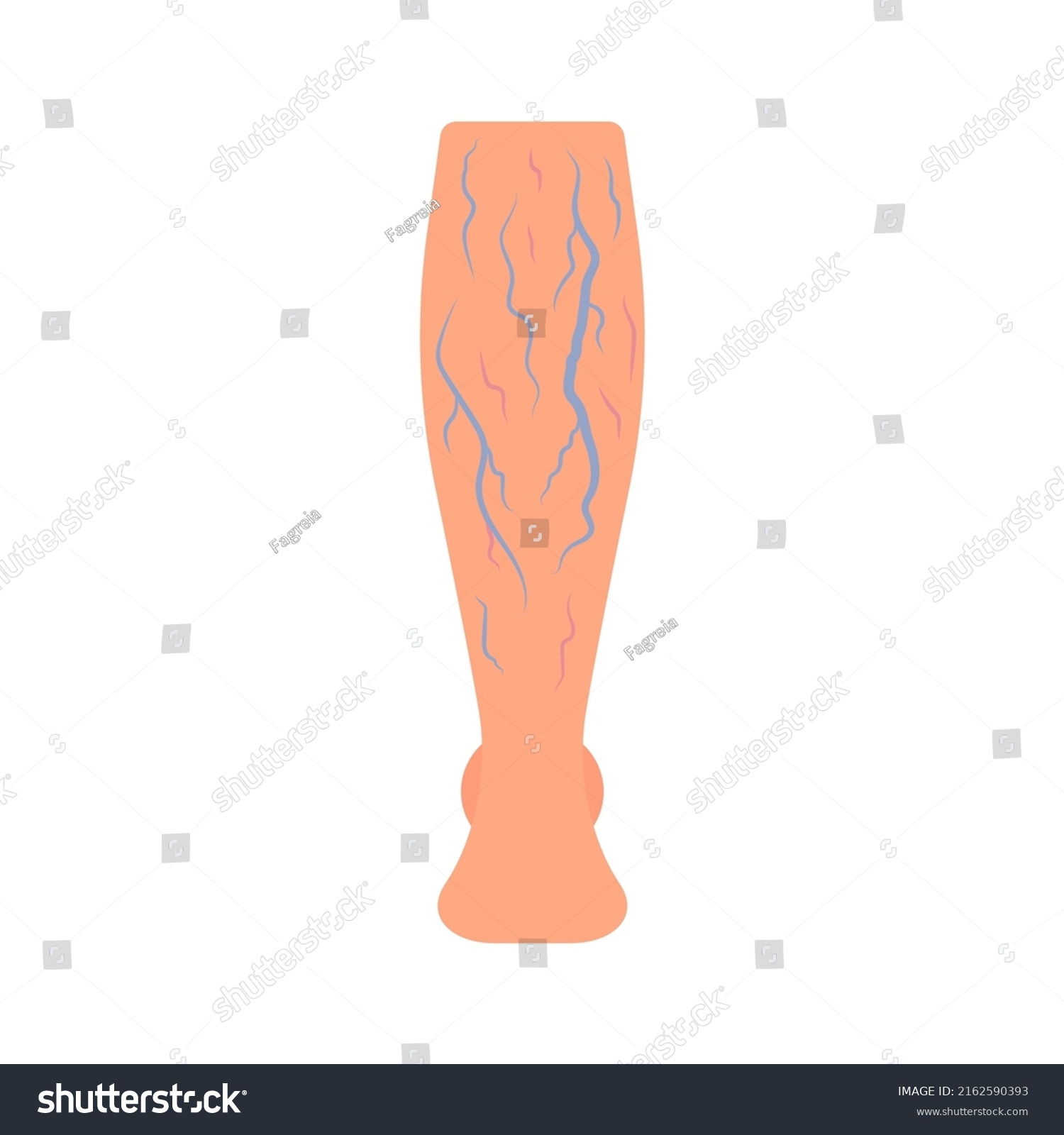 Leg Spider Vascular Vein Pressure Disease Stock Vector (Royalty Free ...