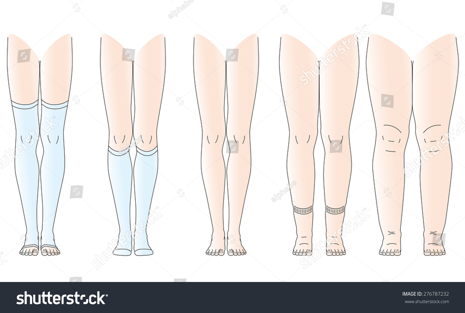 Legs There Is Edema, No Swelling Legs Stock Vector Illustration ...