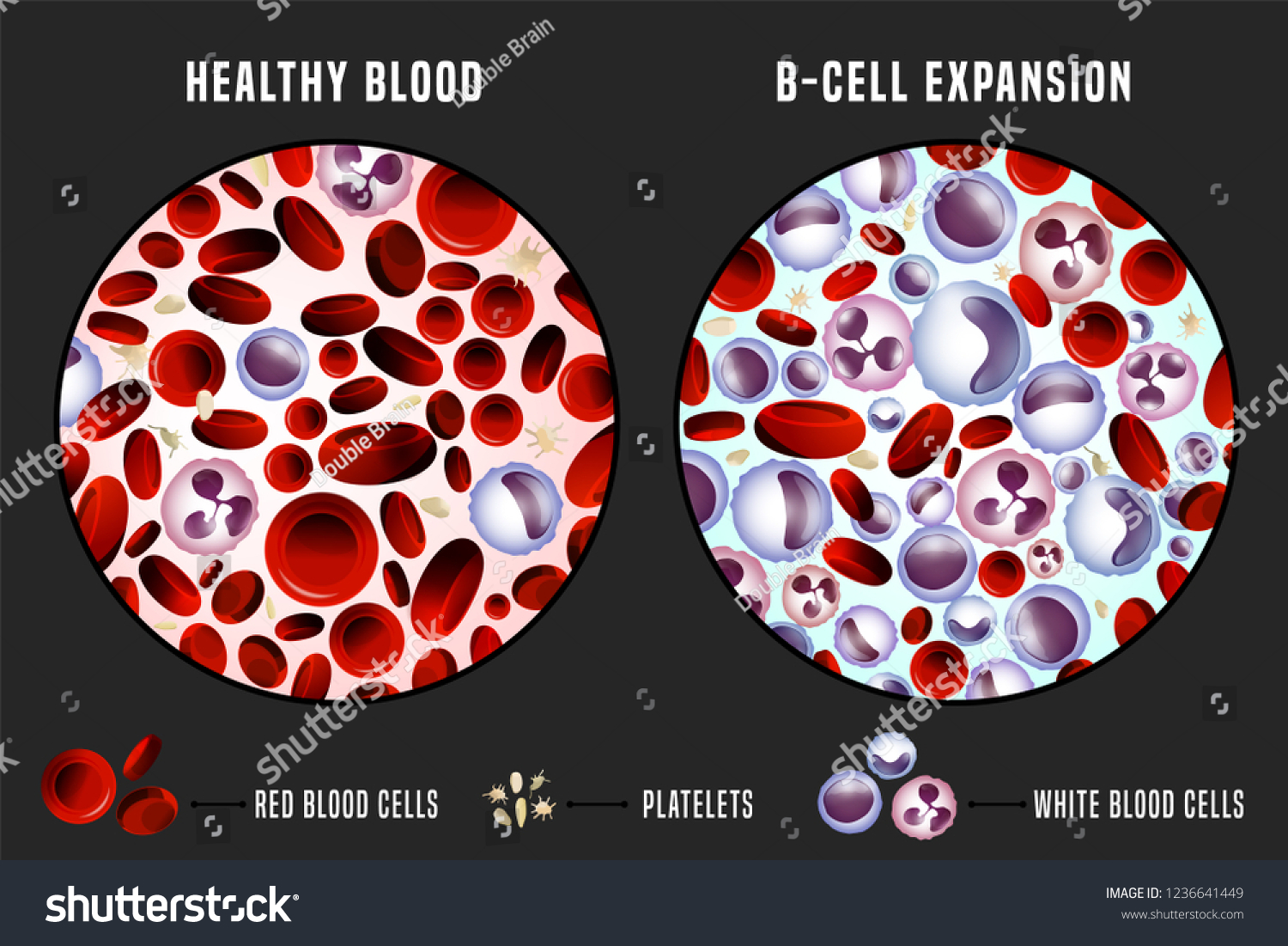 Leukemia Normal Blood Under Microscope Comparison Stock Vector (Royalty ...