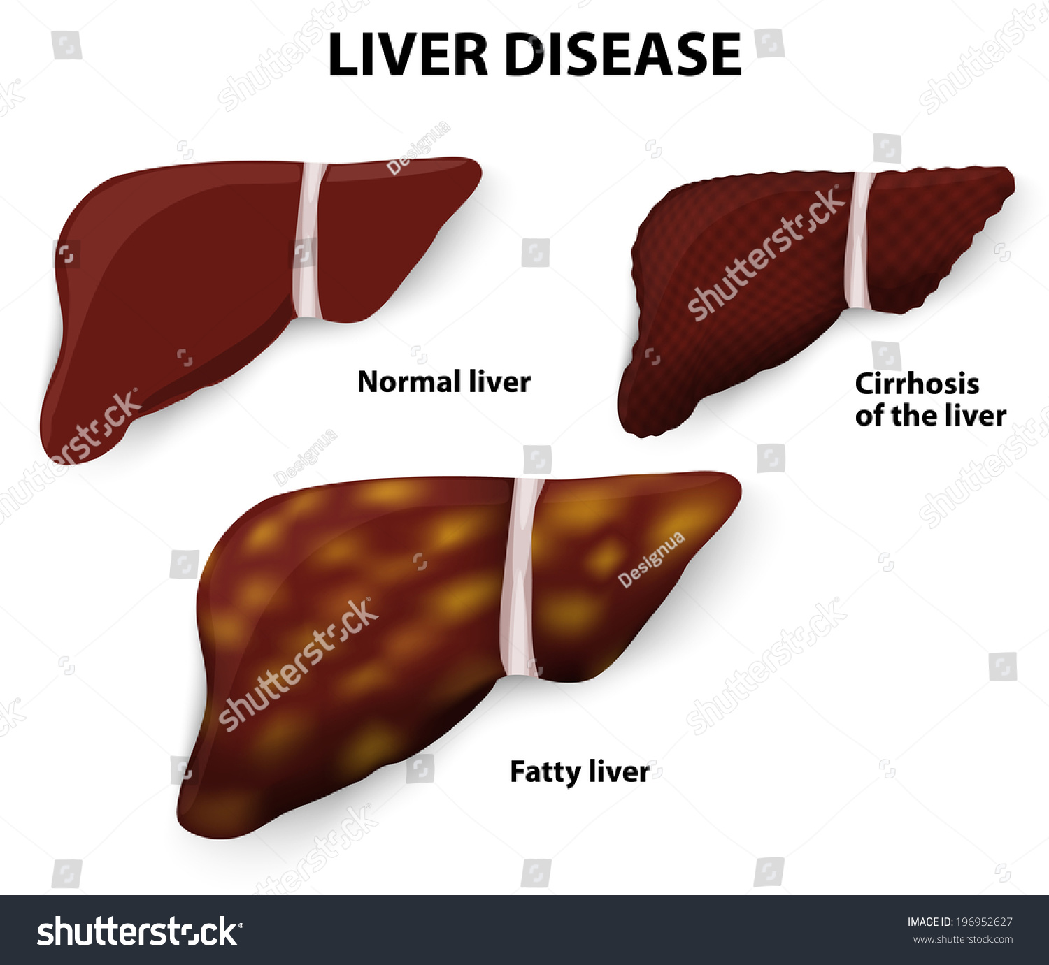 Liver Disease. Cirrhosis Of The Liver, Fatty Liver And Normal Liver ...