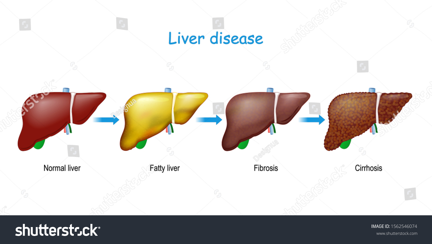 Liver Disease Healthy Internal Organ Fatty Stock Vector (Royalty Free ...