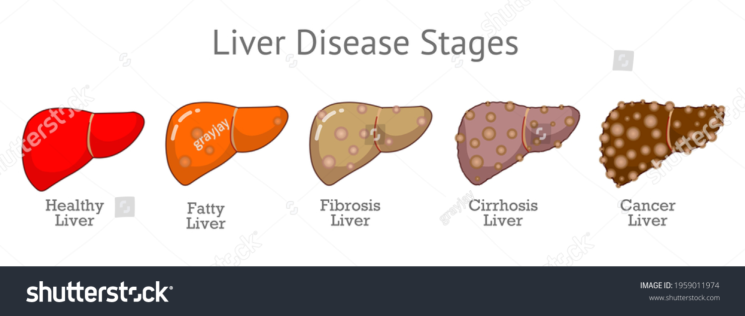 Liver Disease Stages Progression Damage Healthy Stock Vector (Royalty ...