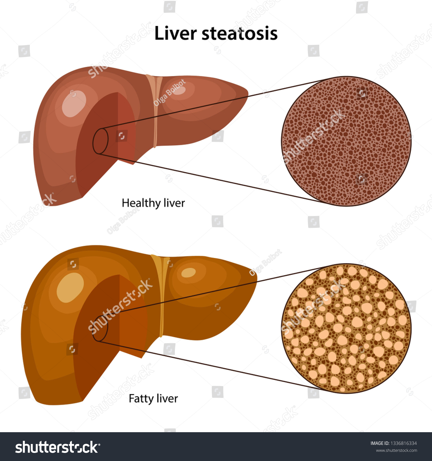 Liver Steatosis Histology Healthy Fatty Liver Stock Vector (Royalty ...