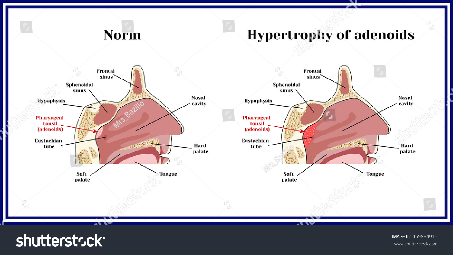 Location Of Adenoids The Structure Of The Nasopharynx Stock Vector | My ...