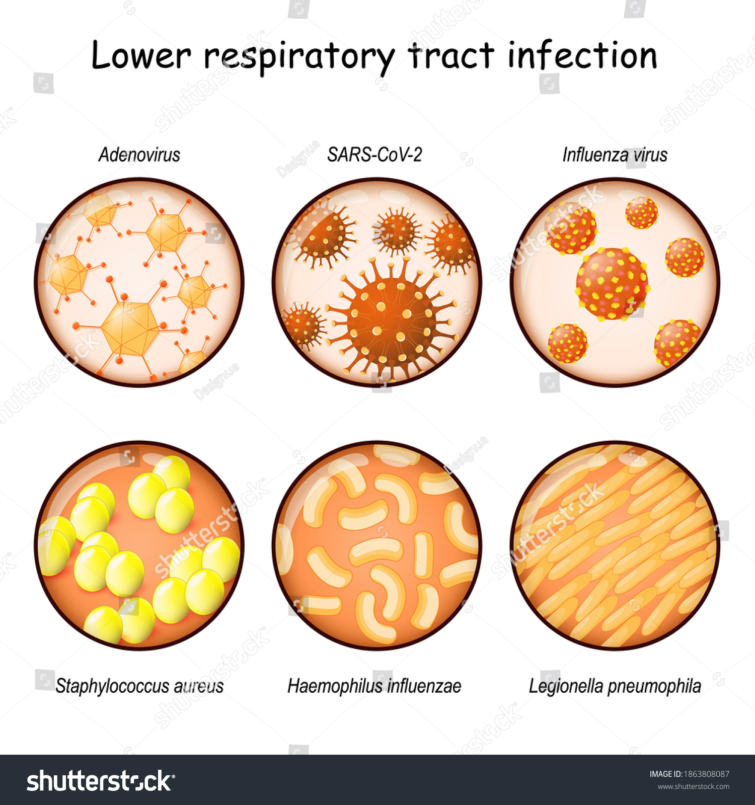 lower-respiratory-tract-infection-closeup-causative-stock-vector