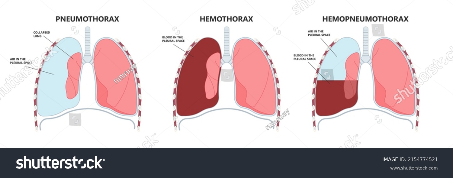 Lung Cancer Collapse Chest Pain Drain Stock Vector Royalty Free 2154774521 Shutterstock