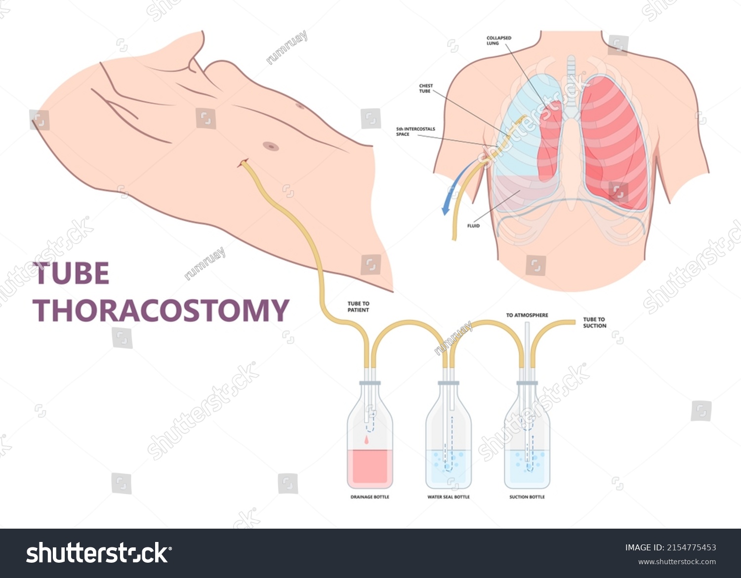 Lung Cancer Collapse Chest Pain Drain Stock Vector (Royalty Free ...