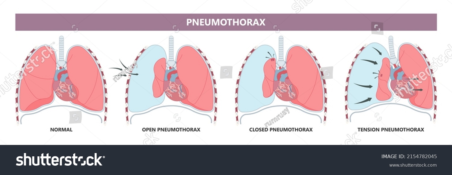 8,032 Ribs lungs Images, Stock Photos & Vectors | Shutterstock