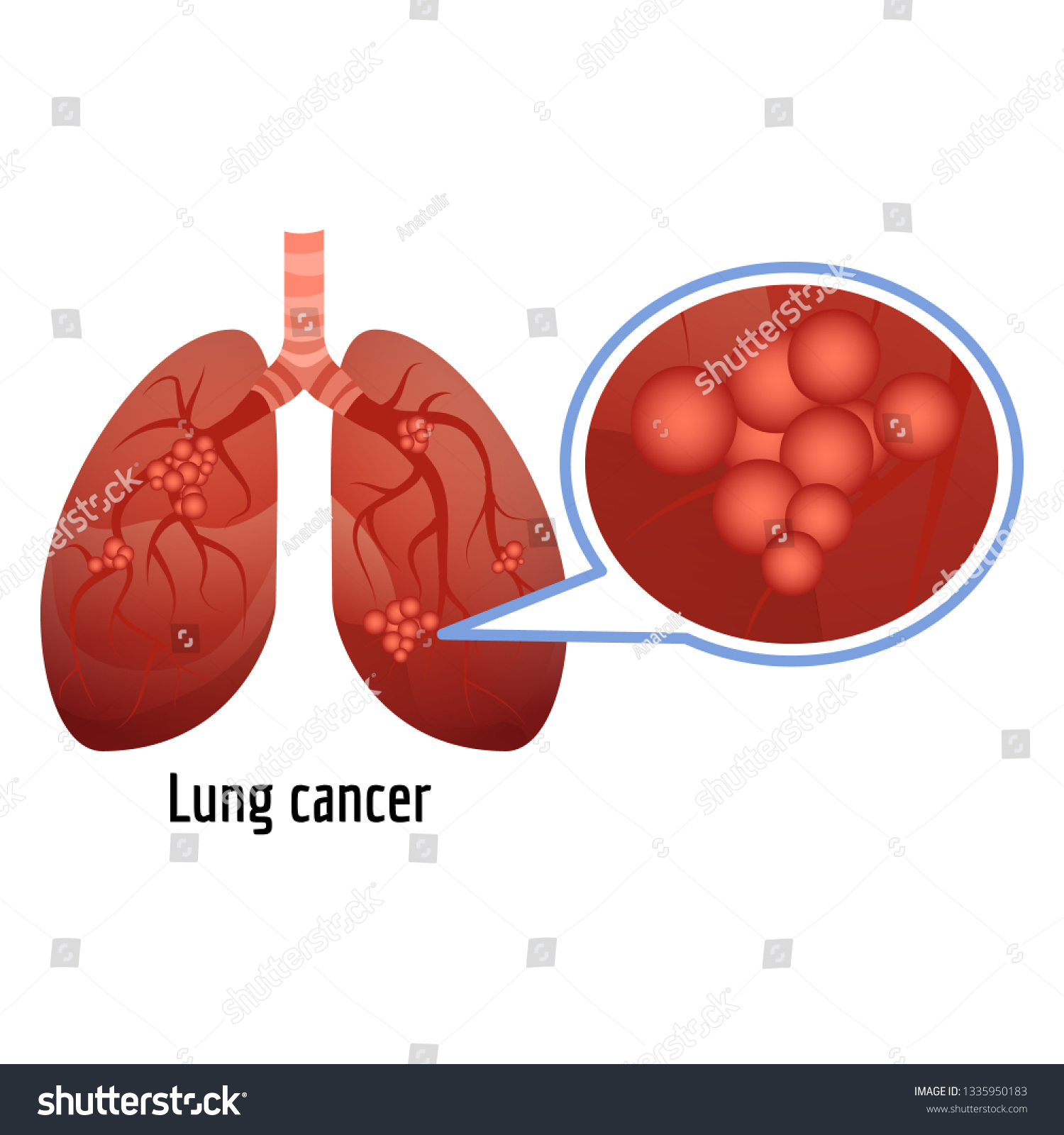 Lung Cancer Icon Cartoon Lung Cancer Stock Vector (royalty Free 