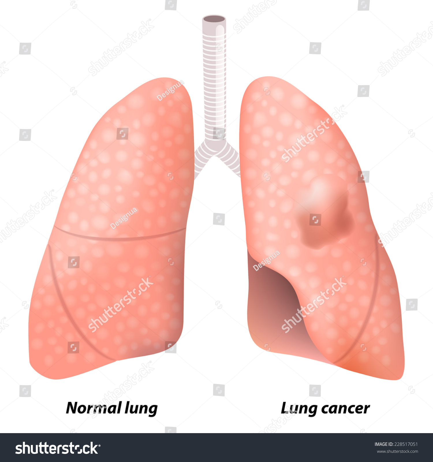 Lung Cancer. This Illustration Shows Malignant Tumor In The Upper Lobe ...