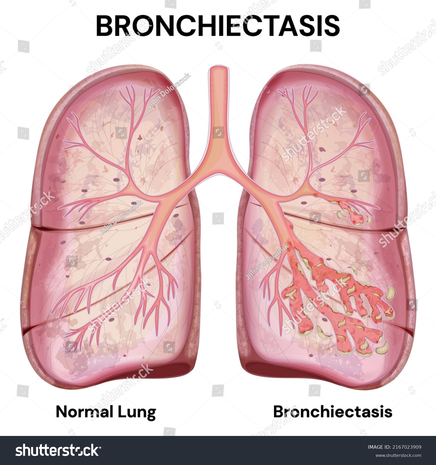 Lung Disease Bronchiectasis Labeled Diagram Normal Stock Vector Royalty Free 2167023909 9208