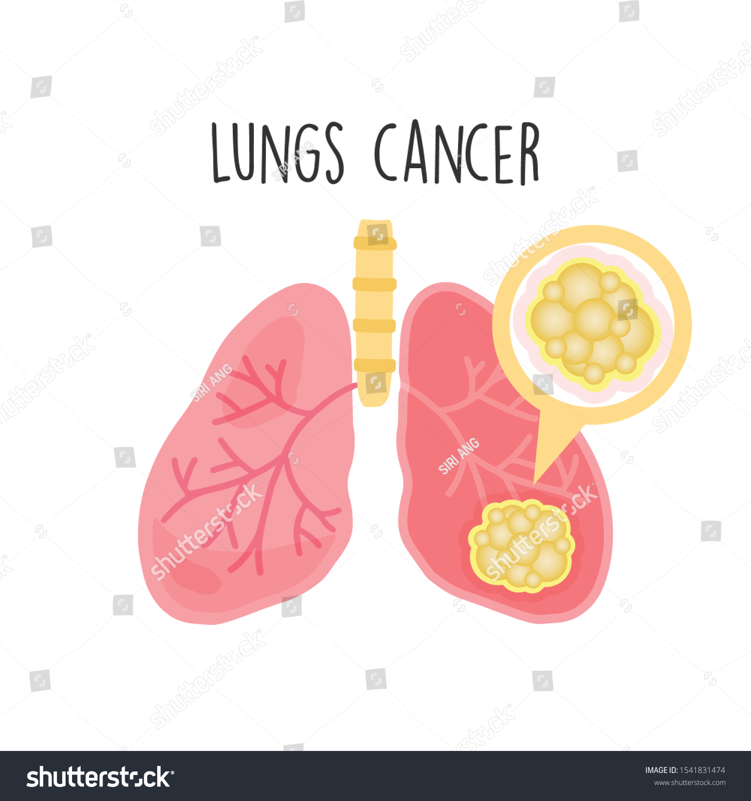 Lungs Cancer Flat Vector Illustration Stock Vector (Royalty Free ...