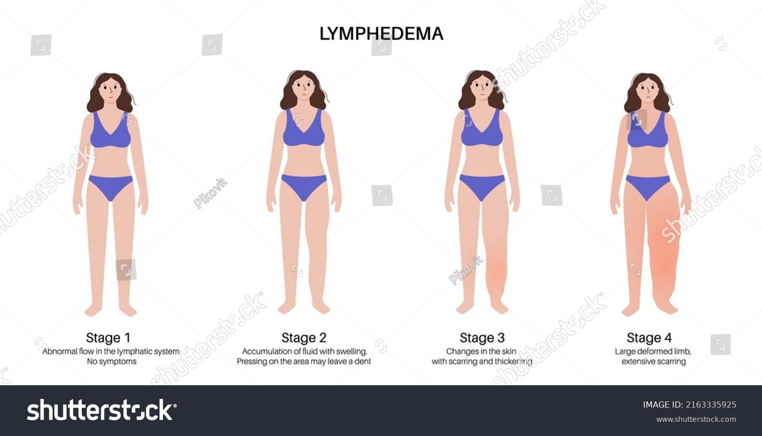 Lymphedema Disease Concept Stages Swelling Female Stock Vector Royalty Free 2163335925 6625