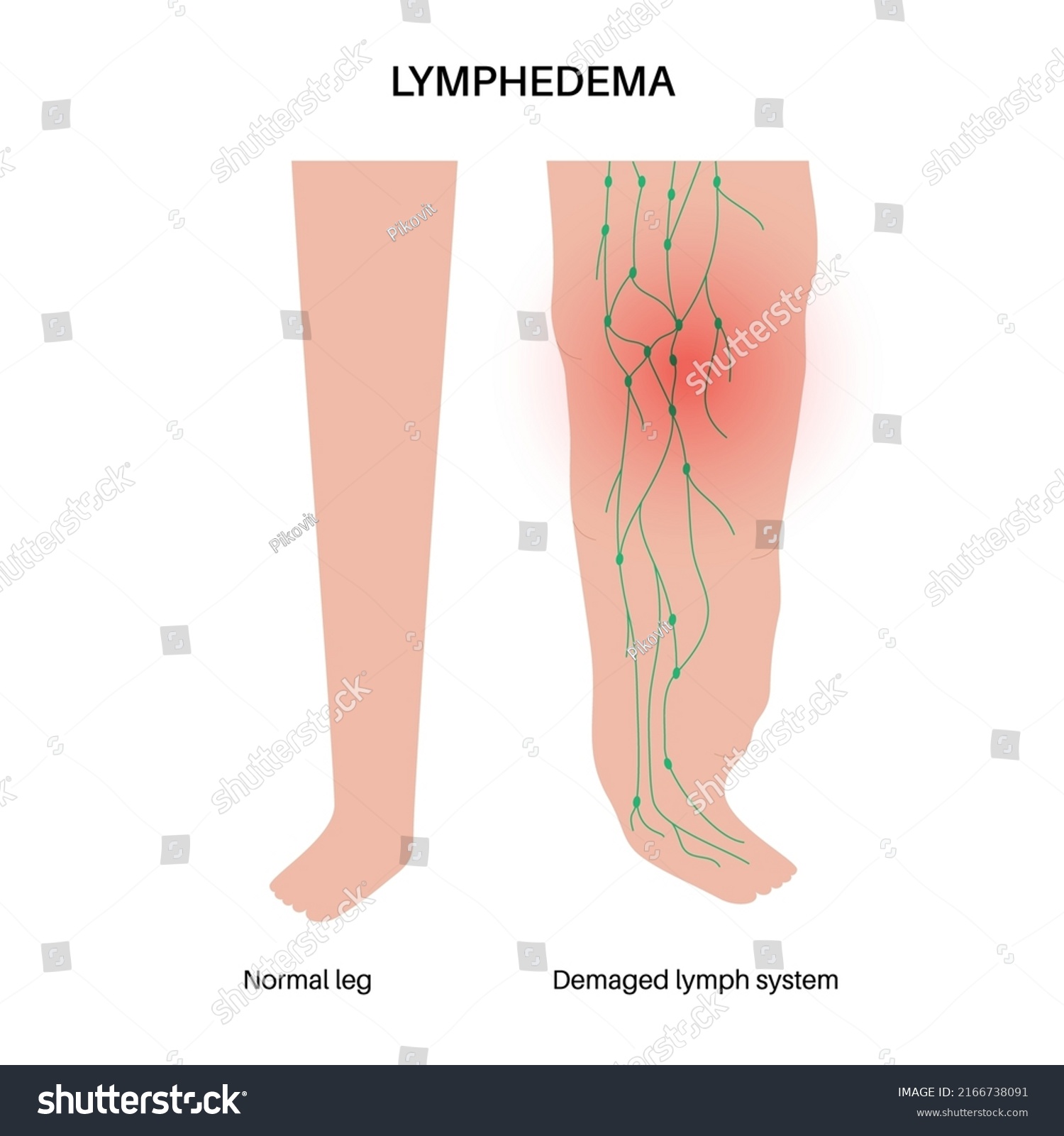 Lymphedema Disease Concept Swelling Female Legs Stock Vector (Royalty ...