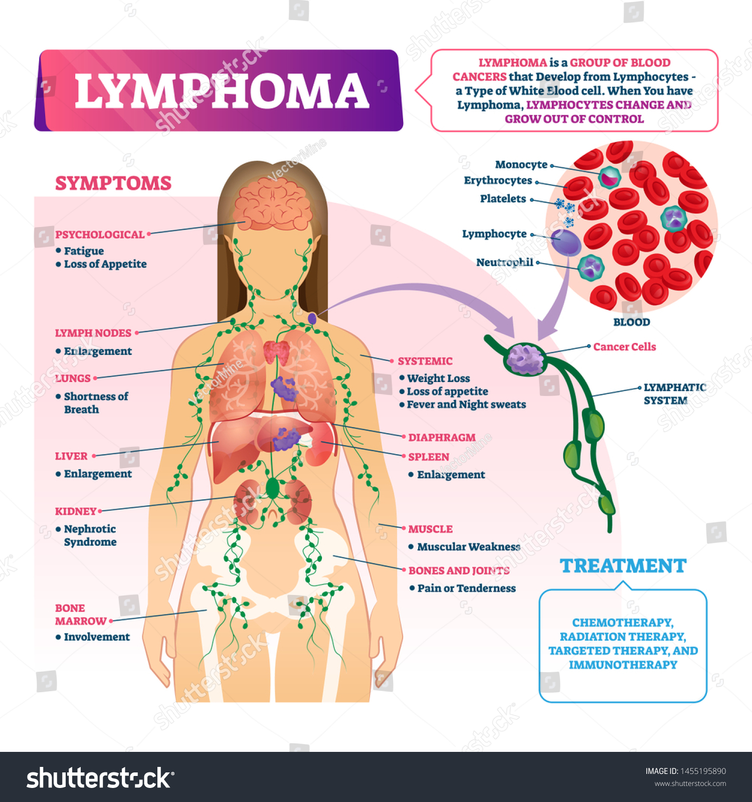 Реферат: Lymphomas Lymphatic Cancers Essay Research Paper Lymphomas