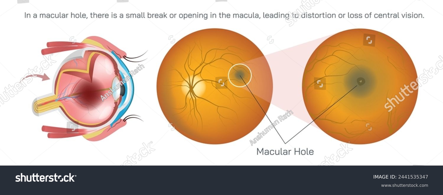SVG of macula is responsible for sharp vision to do activities like reading and driving. In a macular hole, there is a small break or opening in the macula, leading to distortion or loss of vision vector. svg