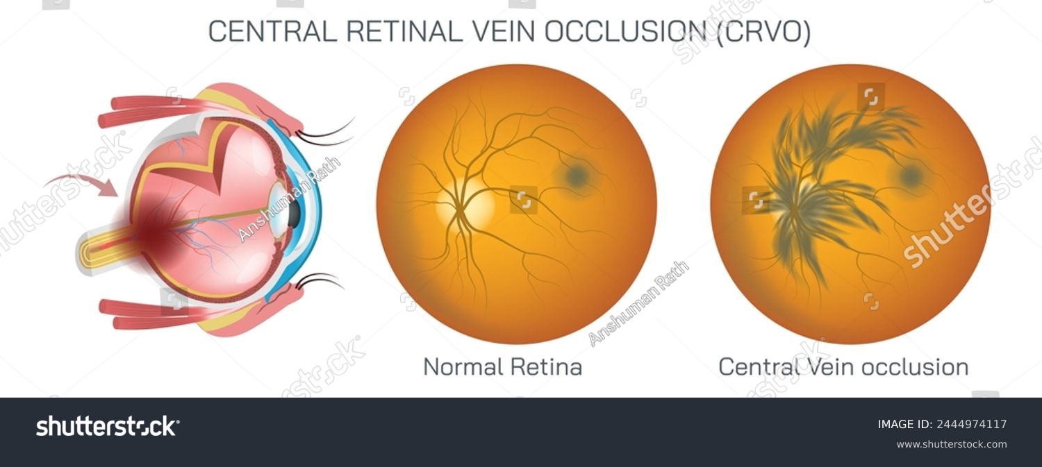 SVG of macula is responsible for sharp vision to do activities like reading and driving. In a macular hole, there is a small break or opening in the macula, leading to distortion or loss of vision vector. svg