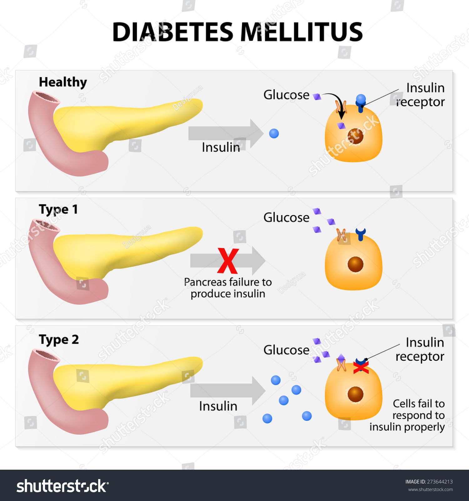 Diabetes Mellitus Pancreas
