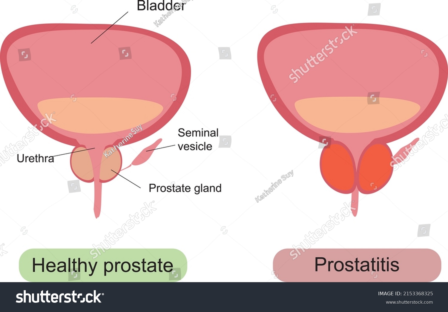 Male Healthy Unhealthy Prostate Prostatic Hypertrophy Stock Vector 