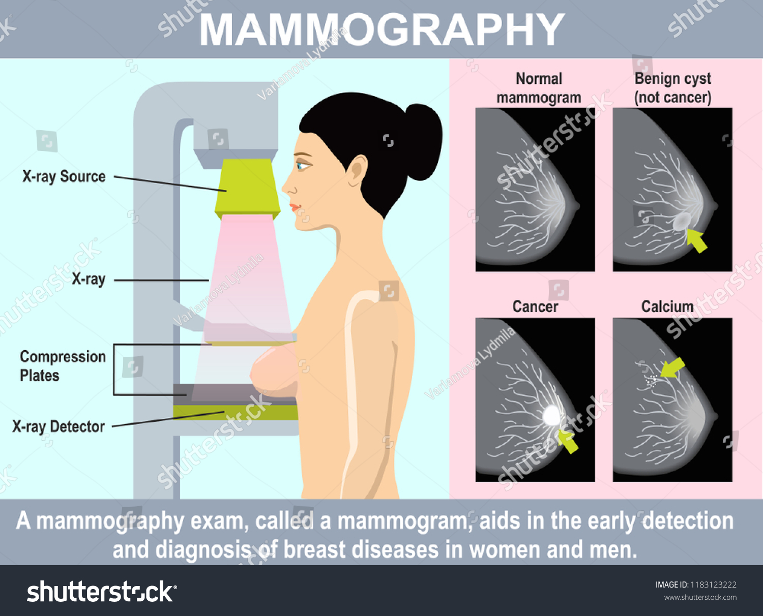 Mammogram Mammography