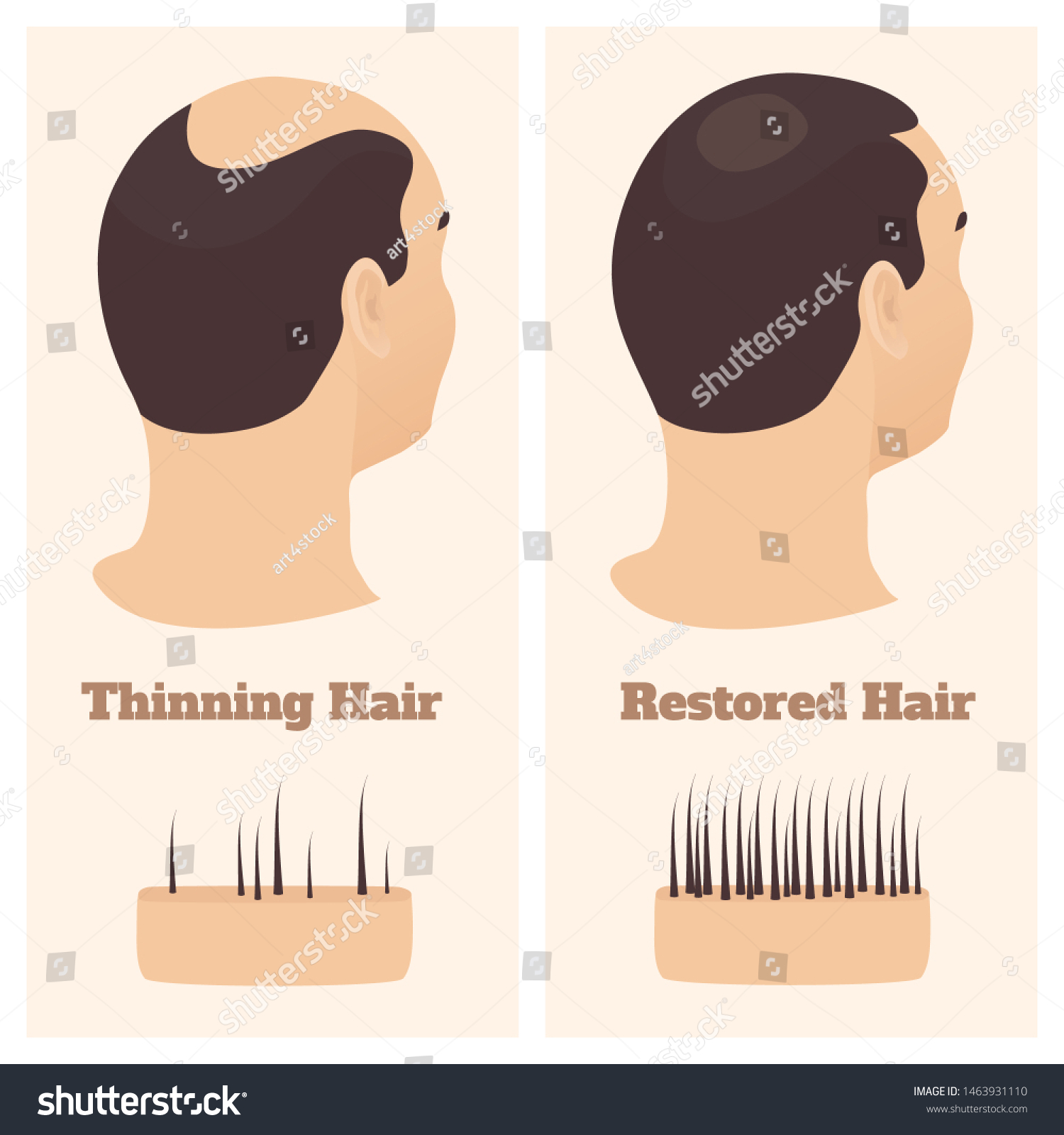 Man Thinning Hair Before After Hair Stock Vector (Royalty Free) 1463931110