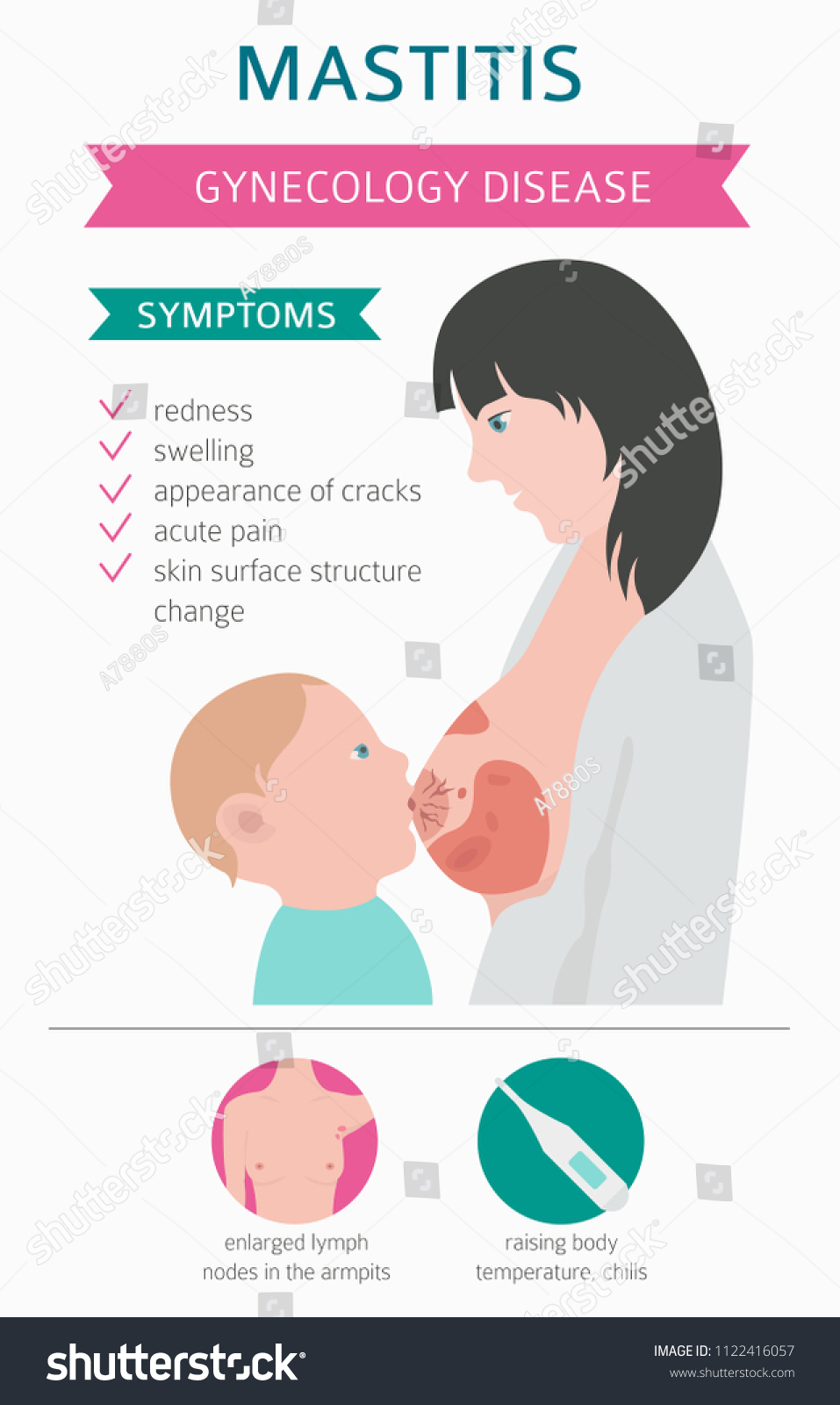 Mastitis Breastfeed Medical Infographic Diagnostics Symptoms Stock ...