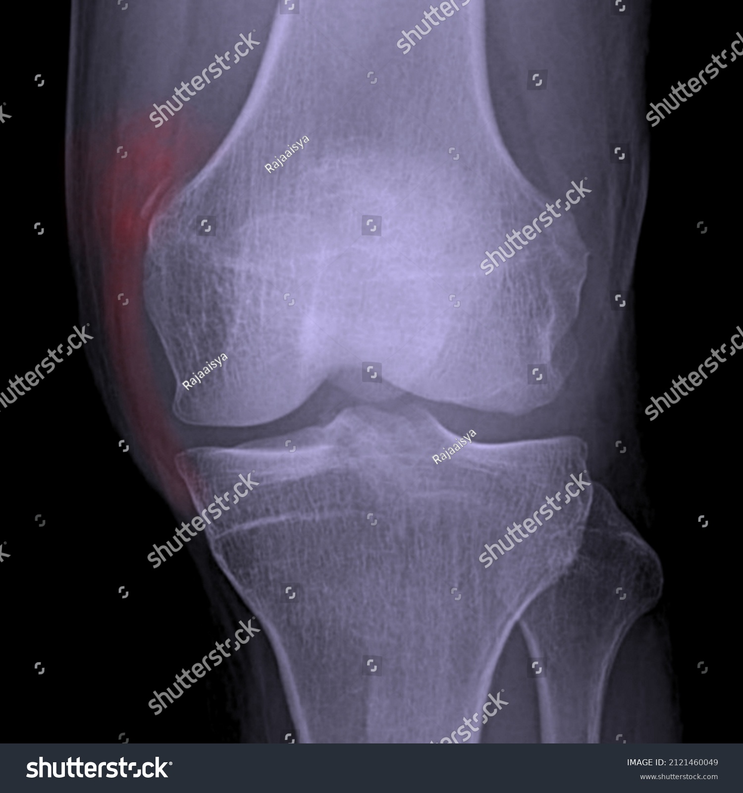 Medial Collateral Ligament Avulsion Fracture Stieda Stock Vector ...