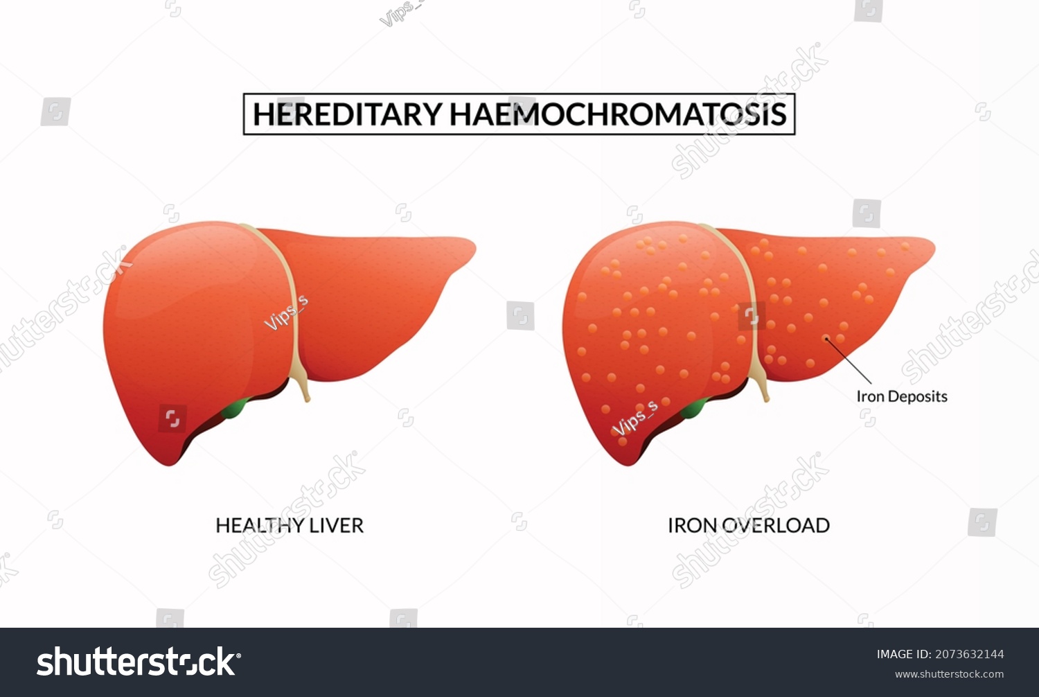 medical-education-chart-liver-disease-hereditary-stock-vector-royalty