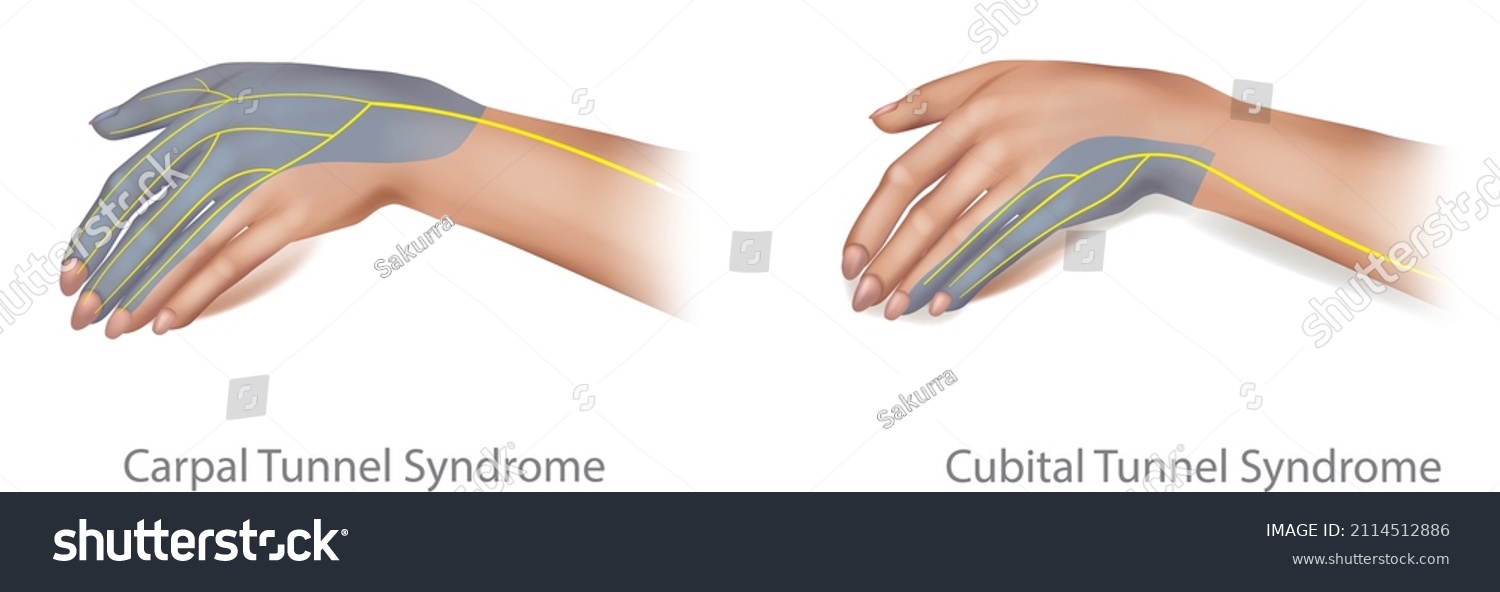 Medical Illustration Cubital Carpal Tunnel Syndrome Stock Vector ...