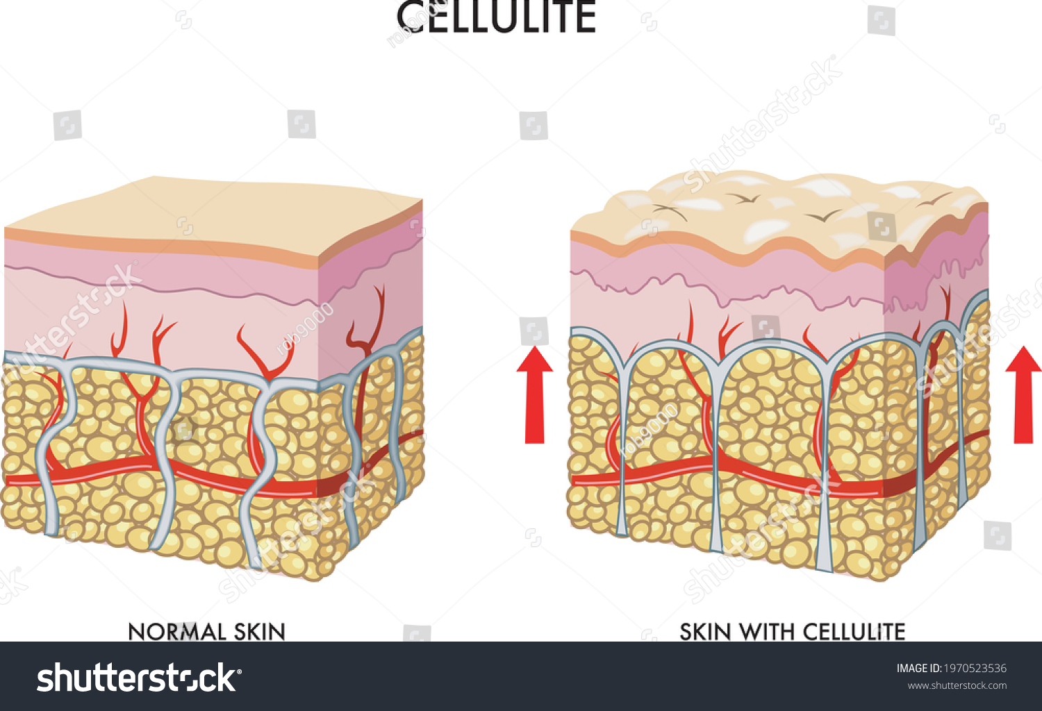 19 Subcutaneous nodules Images, Stock Photos & Vectors | Shutterstock