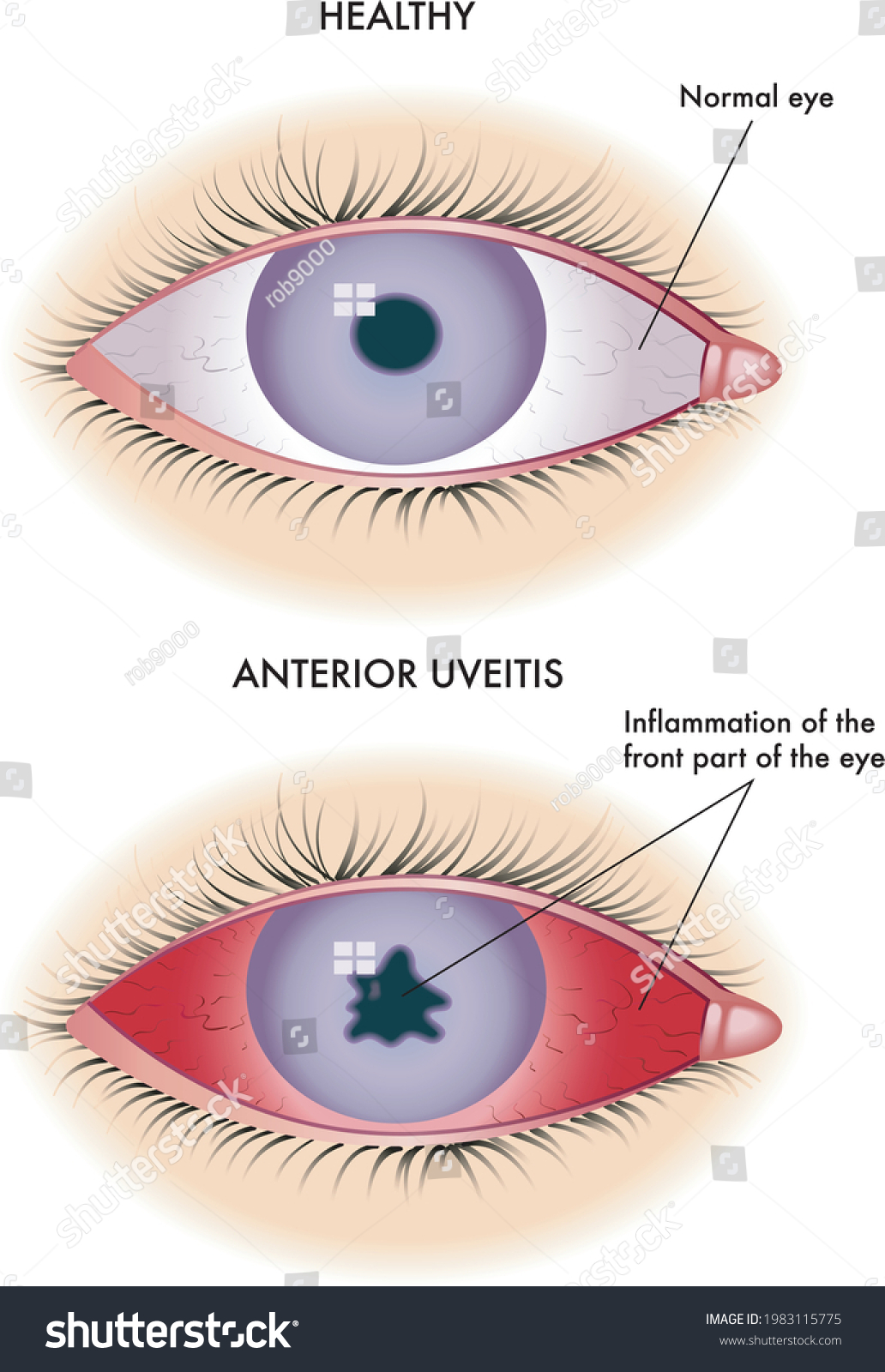 Medical Illustration Symptoms Anterior Uveitis Stock Vector Royalty