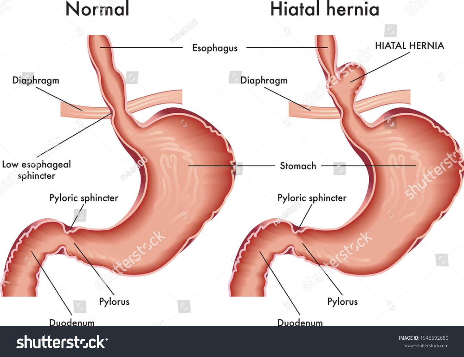 83 Hiatus Hernia Stock Illustrations Images And Vectors Shutterstock