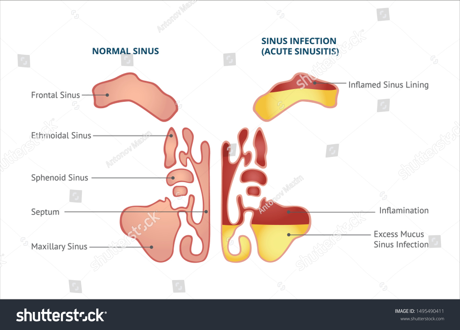 Medical Infographic Sinus Normal Sinus Sinus Stock Vector Royalty Free 1495490411 Shutterstock 4508
