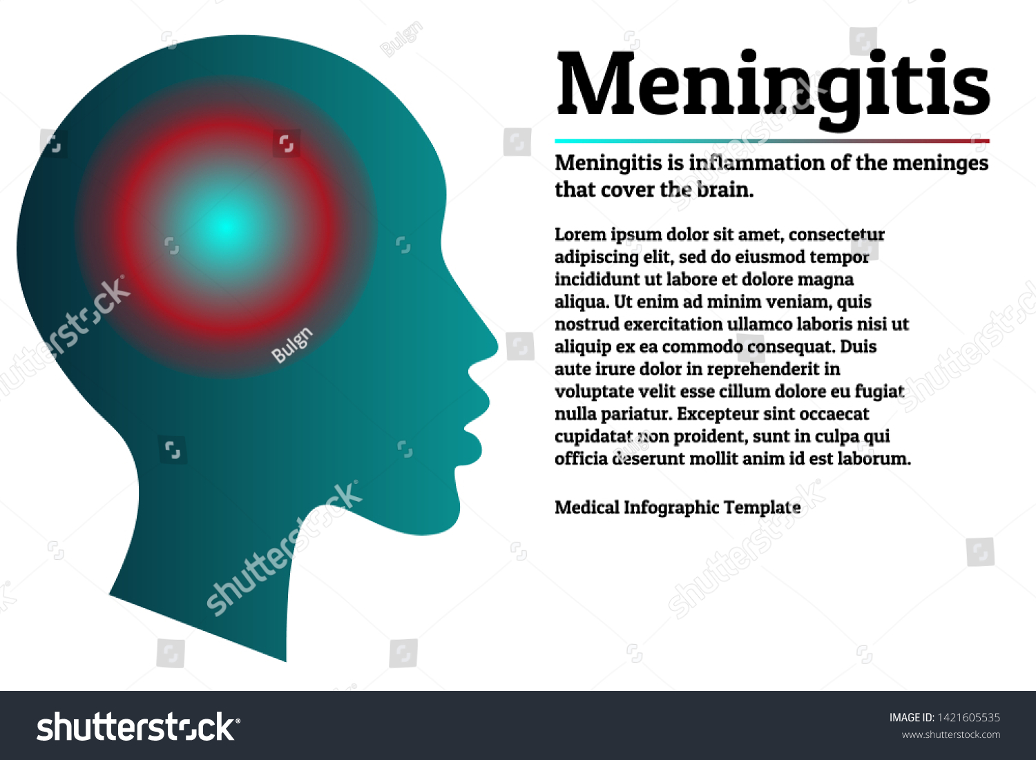 Medical Infographic Template Meningitis Brain Meninges Stock Vector Royalty Free 1421605535 5383